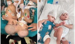 “这种感觉太棒了”：伦敦一名外科医生在14个小时的手术中分离了一对连体双胞胎